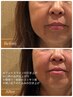 40代からの【本気たるみケア！引き上げ美容鍼】