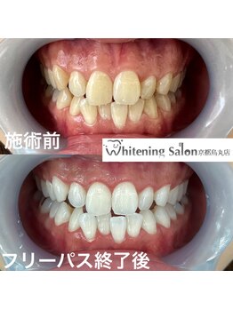 ホワイトニングサロン 京都烏丸店/ホワイトニング施術例