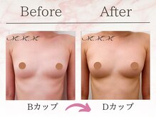 エムエムエム 表参道Luxeサロン(M.M.M)/【バストアップ例】　B→Dカップ
