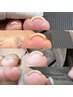 【初回限定】【foot巻き爪ケア】新技術◆ヘイスイッチ両親指¥9,000