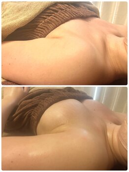 プリマ(prima)/バストアップ症例