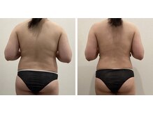 ラナビューティリゾート(Lana Beauty resort)/エステ担当★20代・9きろ減