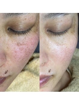 ミーミー 多治見店(MeMe.)/シミケア