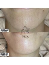 ピュール 鯖江店(PUR)/毛穴サロン/毛穴ケア