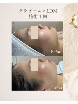 フォルディオ(FORDIO)/ララピール×LDM