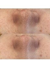 ヴェルシック(Belchic)/痛みもヒリつきもない毛穴ケア