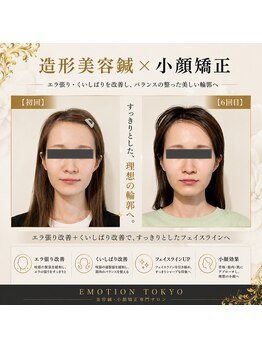 エモシオン トウキョウ(EMOTION TOKYO)/造形美容鍼×小顔矯正