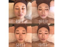 【最強小顔セット】は当店不動の人気NO.1即効性の小顔メニュー。