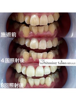 ホワイトニングサロン 京都烏丸店/ホワイトニング施術例