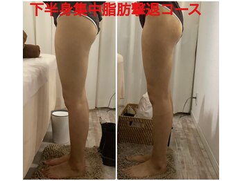 ちゅるん肌ドットコム 心斎橋店(ちゅるん肌.com)/下半身集中1回の変化