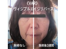 ラ セラフィータ 中目黒/【最先端機器★VAR】
