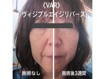 ラ セラフィータ 中目黒/【最先端機器★VAR】
