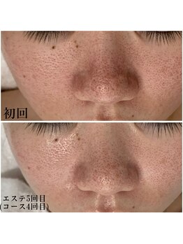 プラセル(Placer)/毛穴開きも少しずつ