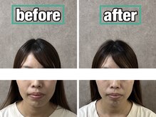 ボニー(Bonnie)/【小顔矯正＋リンパマッサージ】