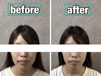 ボニー(Bonnie)/【小顔矯正＋リンパマッサージ】