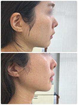 ウニ(uni)/レモンボトル　使用例