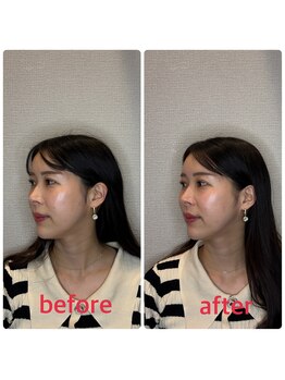 小林整骨院 本町/むくみ、たるみ改善