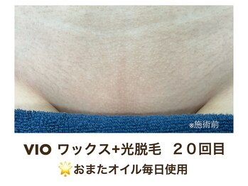 サーラ(SA-RA)/vioワックス＋光脱毛/施術20回目