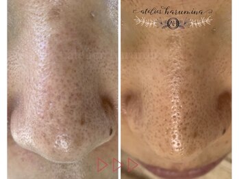 アトリエ ハルミナ(atelier harumina)/ざらつきや黒ずみには毛穴洗浄♪