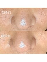 エクラ バイ シャンリィ(eclat by shanLy)/毛穴油はしっかり対処！