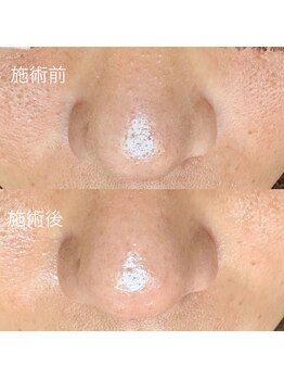 エクラ バイ シャンリィ(eclat by shanLy)/毛穴油はしっかり対処!