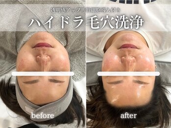 フェイシャルヴィム(FACIAL VIM)/毛穴洗浄で素肌をクリアに