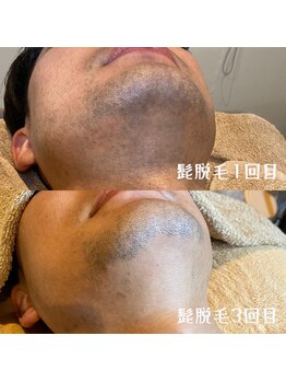 アルト(ALTO)/ビフォーアフター