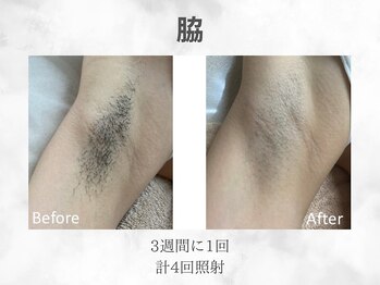 ベル(Belle)/メンズ脇脱毛