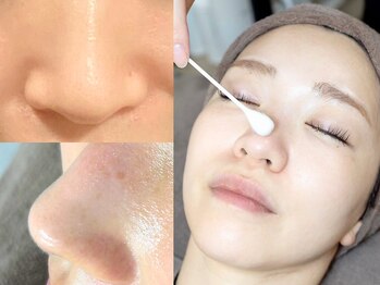 スリースリー(THREE THREE)の写真/毛穴黒ずみ・毛穴開きも改善◎話題の[水光肌育￥9,900~]恵比寿駅徒歩3分のピーリング専門店｜口コミ高評価