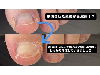 爪切り直後から激痛！？