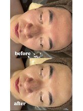 エクラ(ECLAT)/赤みや肌荒れを改善！