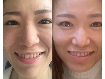 サクラ(SAKURA)/速攻改善コース◎小顔