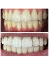 ラブホワイトニング 渋谷店(LOVEホワイトニング)/初回２回照射ホワイトニング