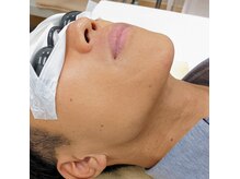 ブリーゼ湘南/ヒゲ脱毛