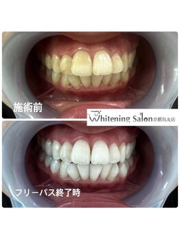 ホワイトニングサロン 京都烏丸店/ホワイトニング 施術例