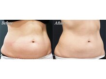 ブリエル(BRILLER)/脂肪冷却（お腹）