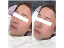 ピュア 川越店/光フェイシャル＋小顔美容液