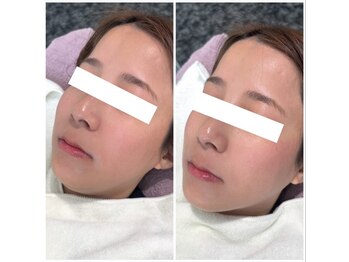 ピュア 川越店/光フェイシャル+小顔美容液