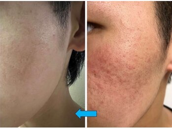 ファルファラ(farfara)/天然ハーブピーリング