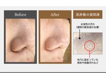 ベラピエル(BELLA Piel)/毛穴洗浄