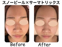 ラディアント たまプラーザ/スノーピール×サーマトリックス