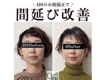 キュープ 高崎店(Qpu)/小顔頭蓋骨矯正＋リンパケア