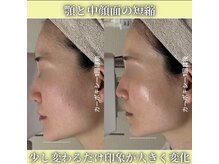 ハニエル(Haniel)/カーボキシー症例