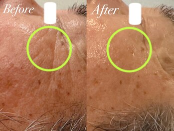 ルノン(Lunon)/ララピール