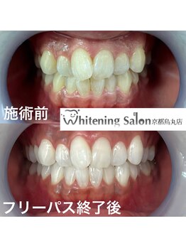 ホワイトニングサロン 京都烏丸店/ホワイトニング施術例
