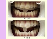 ココティ ホワイトニング(Cocotii)/ビフォーアフター