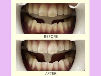 ココティ ホワイトニング(Cocotii)/ビフォーアフター