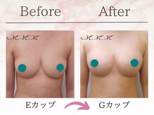 エムエムエム 表参道Luxeサロン(M.M.M)/【バストアップ例】　E→Gカップ