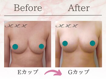 エムエムエム 表参道Luxeサロン(M.M.M)/【バストアップ例】　E→Gカップ