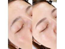 眉毛+フェイスwaxのセットが人気☆毛穴も綺麗&つるんと卵肌に♪